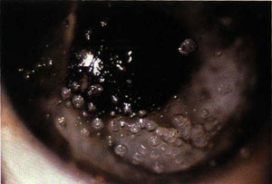 Clemson Eye - Contact Lenses Clemson Eye - Contact Lenses