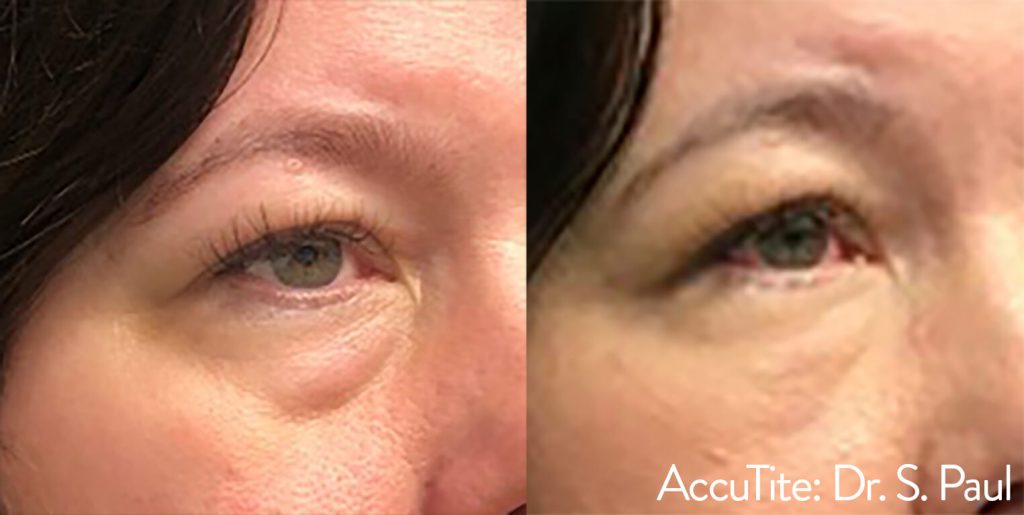 ACCUtite Before and After