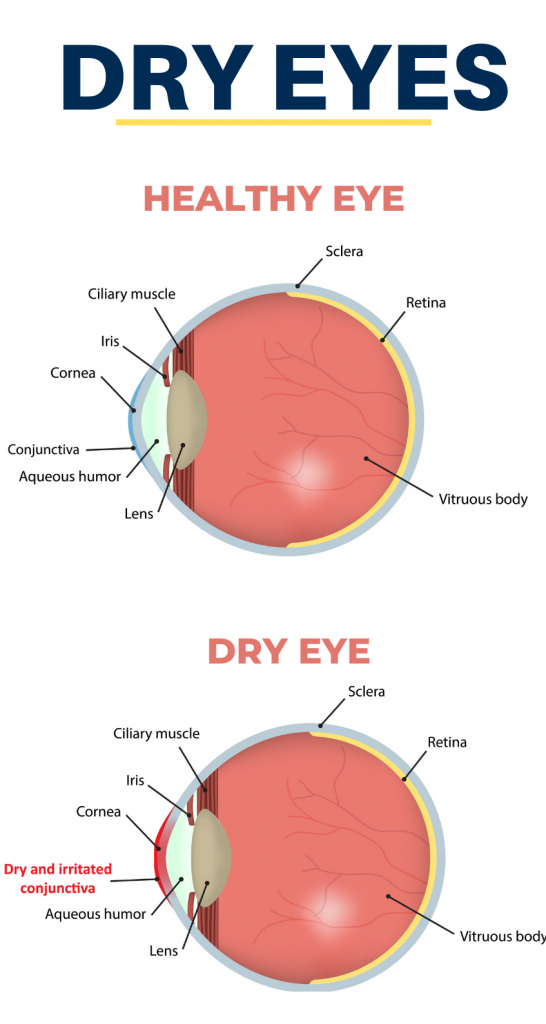 Dry Eyes Diagram; Healthy Vs Dry Eye