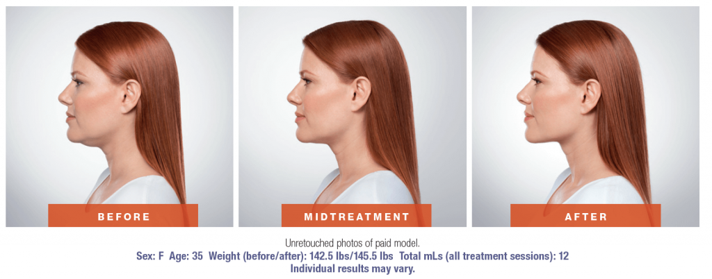 Kybella Treatment