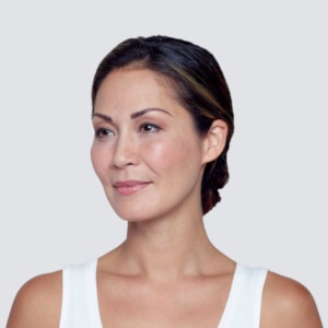 Restylane Lyft Before