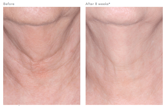 ReVision Nectifirm® Before and After