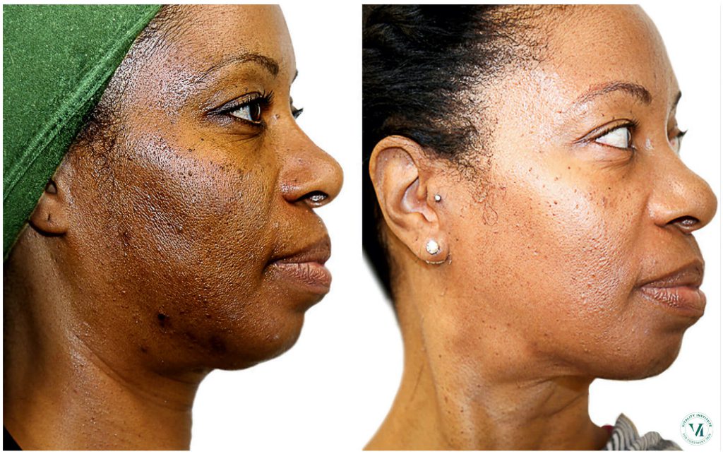 Pigmentation Treatment with Chemical Peels
