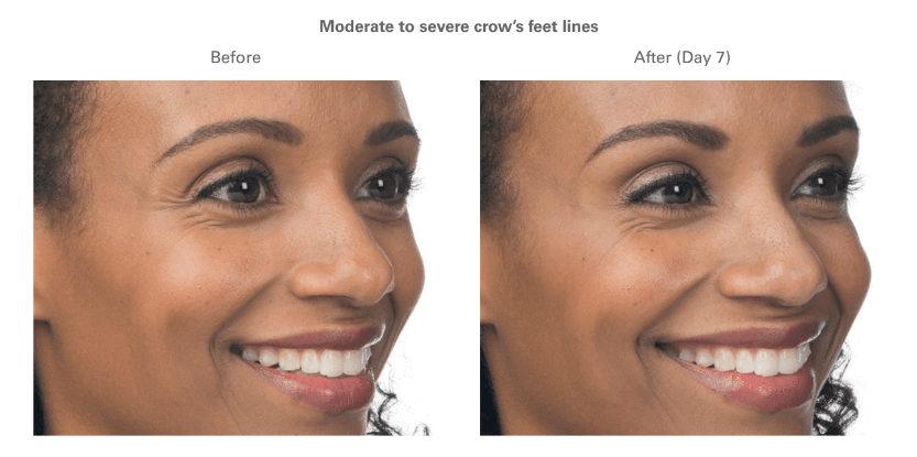 Woman with moderate to severe frown lines with botox treatment