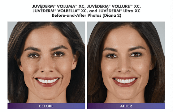 Before and After of woman with juvederm treatment