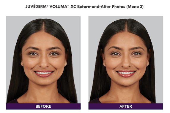 woman with juvederm treatment