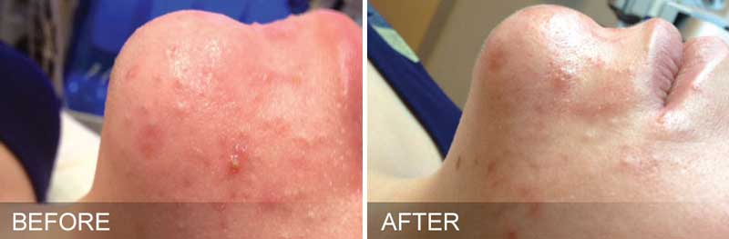 Before and after of congested Skin