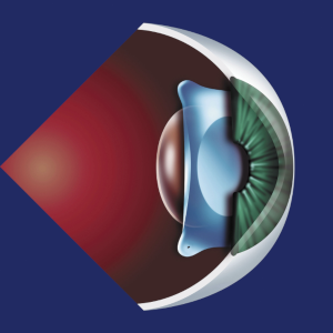 Lens Implant