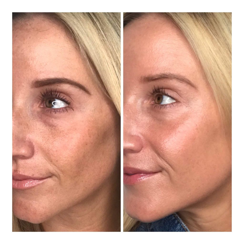 Halo Treatment Before and After