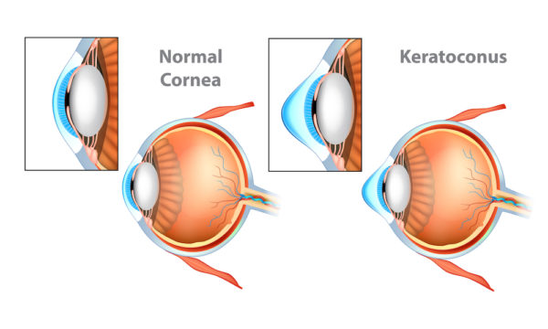 Normal Cornea vs Cornea with Keratoconus