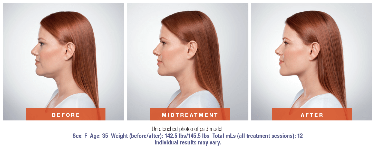 KYBELLA before and after