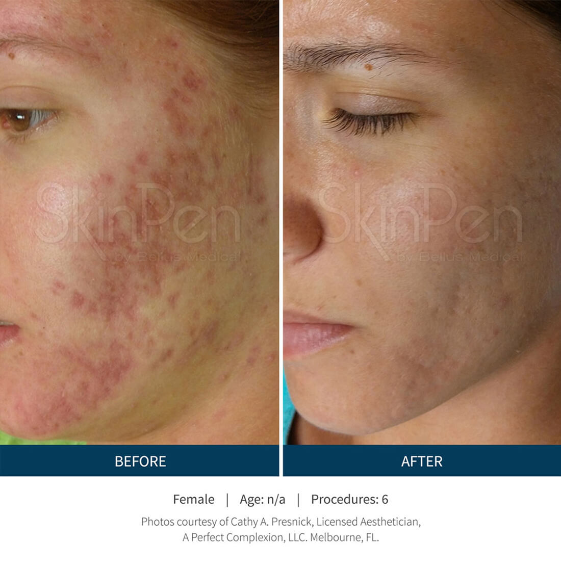 Microneedling Before and After